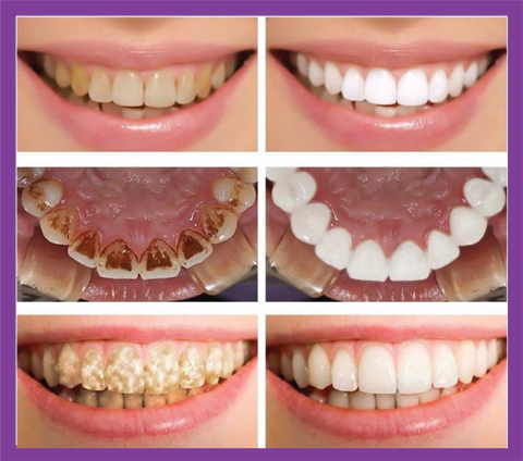 Teeth Whitening Toothpaste